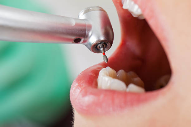 Best Broken or Cracked Tooth Emergency Dentist in Ephraim, UT